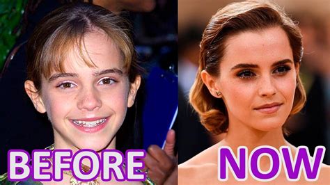 Women And Time Emma Watson Before аnd Now Sarah Duchess Of York Emma Watson Botox Before