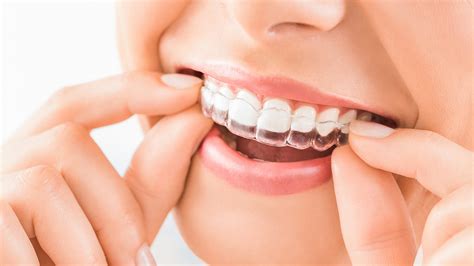 Clear Aligner Myths Kirkland Premier Dentistry