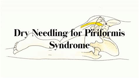 When treating piriformis syndrome the goal is to help the piriformis loosen and relax. Dry Needling for Piriformis Syndrome - Access Health ...