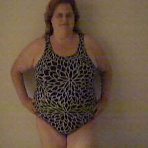 Gastric bypass is one of the three most common types of weight loss (bariatric) surgery carried out in the uk. Surgery Panniculectomy Reviews - Viewpoints.com