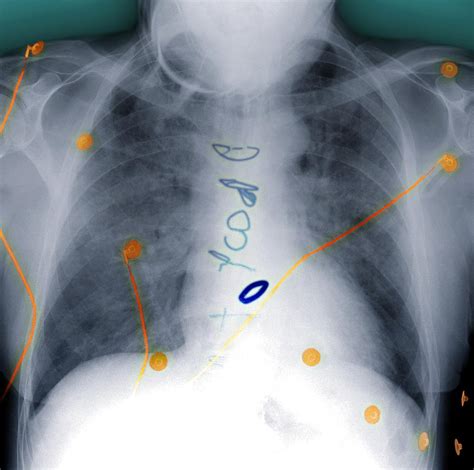 Heart Surgery X Ray Photograph By Du Cane Medical Imaging Ltd Pixels