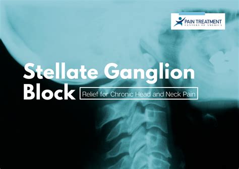 Stellate Ganglion Relief For Chronic Head And Neck Pain
