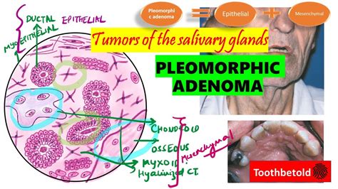 Pleomorphic Adenoma Salivary Gland Tumors Detailed Textbook