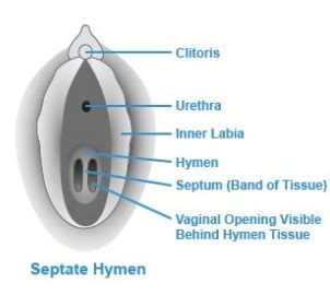 Hymen Location Pictures Surgery And Repair