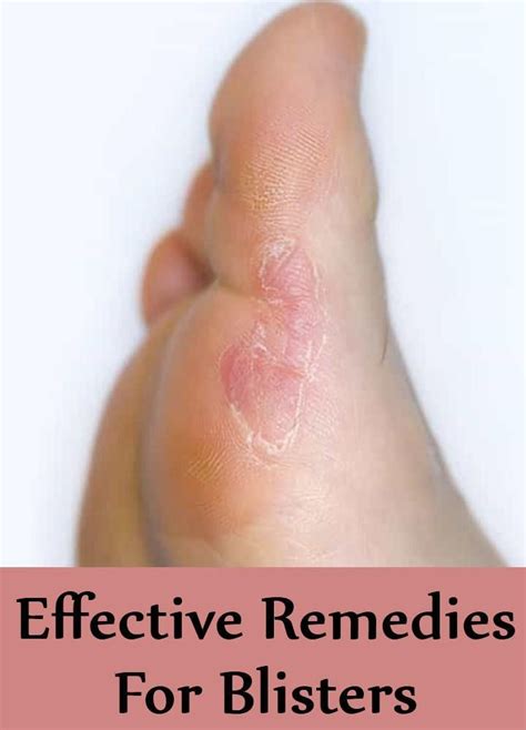 9 Effective Treatments For Blisters Blister Treatment Blister