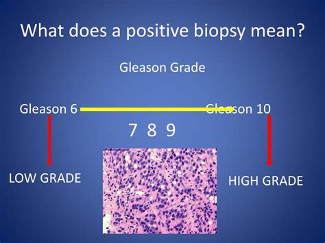 More often it's caused by other things like an. PPT - Prostate Cancer Treatment: What's Best For You ...