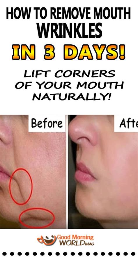 How To Remove Mouth Wrinkles In 3 Days Lift Corners Of Your Mouth