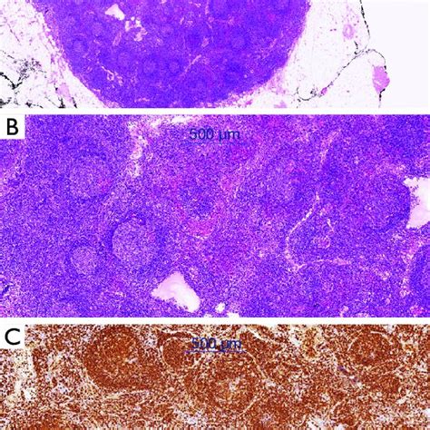 Cervical Lymph Node Involvement By Marginal Zone Lymphoma A