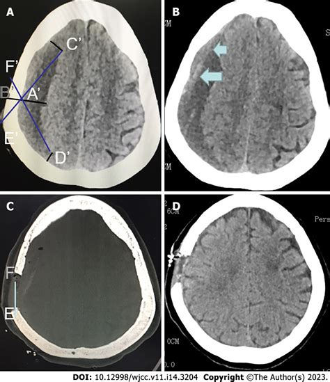 Positioning And Design By Computed Tomography Imaging In Neuroendoscopic Surgery Of Patients