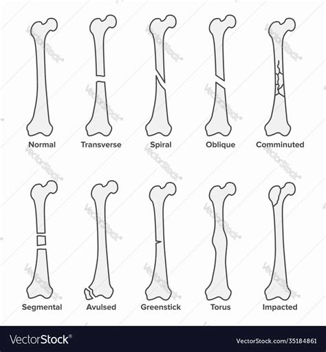 Types Of Bone Fractures Medical Educational Vector Image The Best