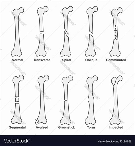 Types Fractures Broken Bones Royalty Free Vector Image