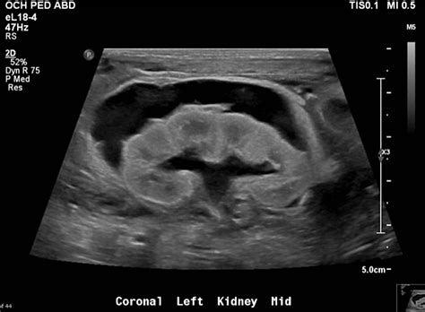 Cureus Renal Protective Urinoma Formation In A Newborn Boy With Posterior Urethral Valves