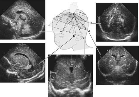 Neurosonography In Neonates Infants And Children Radiology Key