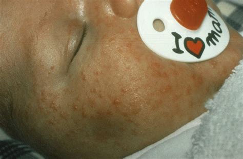 Erythema Toxicum Neonatorum Huidhuis