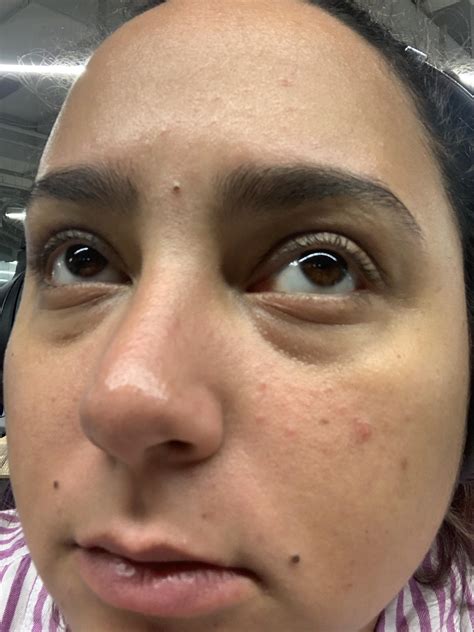 Skin Concern Redness Around Cheeks And Nose Bumpy Forehead Wont Go