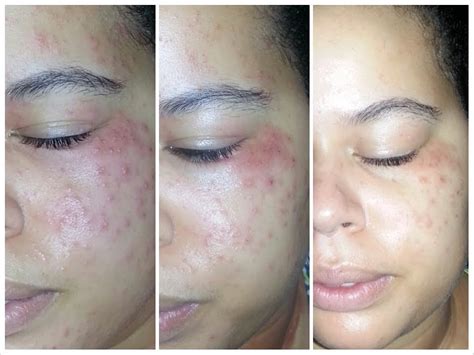 Allergic Reaction Makeup Rash Tutorial Pics