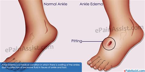 What Causes Ankle Edema And Natural Ways To Get Rid Of Ankle Swelling