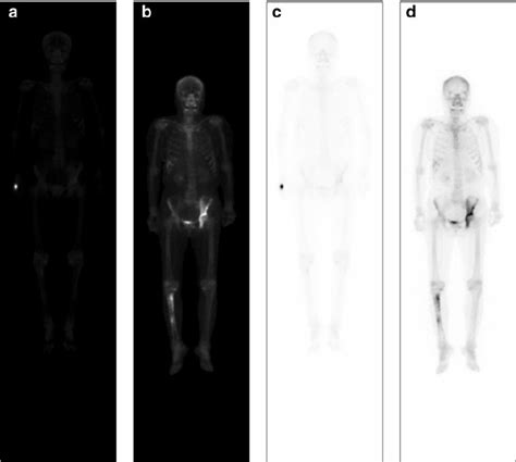 Sample Images Of Whole Body Bone Scans A Previous Image B Current