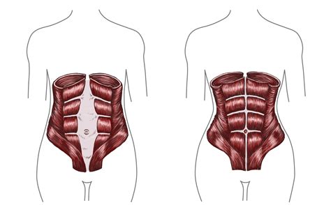 Fixing Diastasis Recti Post Pregnancy Belly In 10 Minutes Of Daily