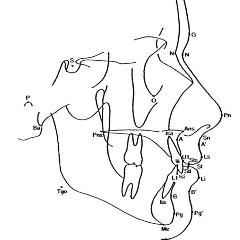 Dentoskeletal And Soft Tissue Cephalometric Landmarks Used In The Download Scientific Diagram