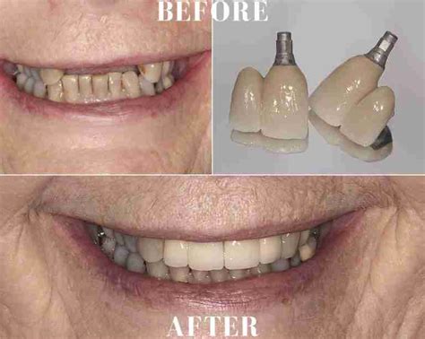 Case 3 Implant Crowns Front Teeth Ocean Breeze Prosthodontics