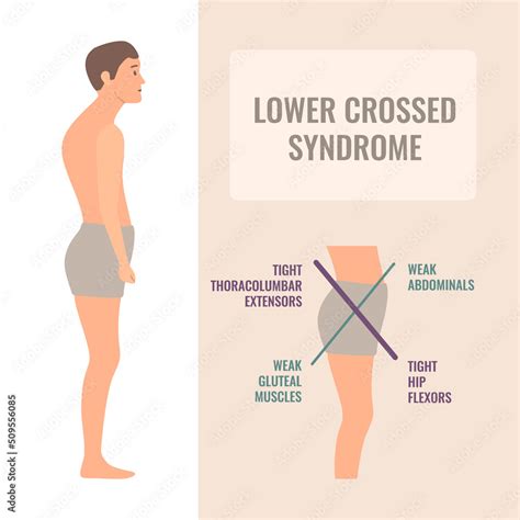 Lower Crossed Syndrome Medical Diagram Crooked Man With Muscle Strength Imbalance Weak And