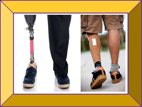 Prosthetics And Orthotics From My Care Lower Limb Prosthesis