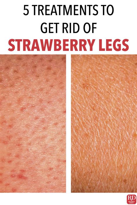 How To Get Rid Of Strawberry Legs 5 Treatments That Work Strawberry
