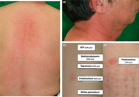 Delayed‐type Cutaneous Drug Eruption Due To Oral Prednisolone Akaike