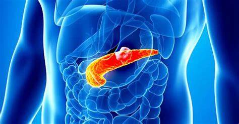 Диета онкология поджелудочной железы Рак поджелудочной железы - диагностика, первые признаки, симптомы и Рак поджелудочной железы - диагностика, первые признаки, симптомы и Диета онкология поджелудочной железы