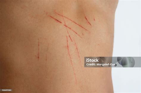 Cat Scratches On The Skin Skin Wounds Stock Photo Download Image Now