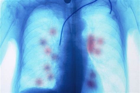Cubas New Lung Cancer Treatment Could Go Global As Us Eases Relations