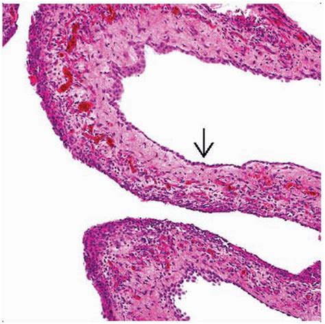 Benign adenomatoid mesothelioma pathology outlines. Multicystic Peritoneal Mesothelioma | Basicmedical Key