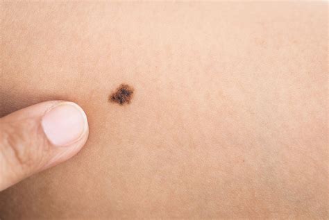 Heres How To Check If Your Mole Is Cancerous Health The Jakarta Post