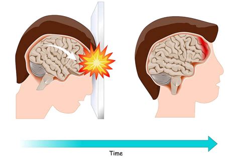 Whats The Connection Between A Tbi And Stroke