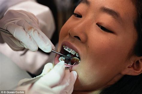 Fake Braces Trend Is A New Status Symbol For Asian Teenagers But Could They Kill Wearers