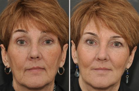 What Are The Benefits Of Dermal Fillers Boston Dermal Fillers