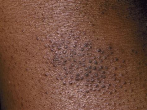 Tottenham Download 22 Eczema Psoriasis On Black Skin