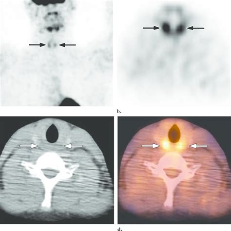 Transverse Fdg Pet Scan A And Fused Pet Ct Image B Show Bilateral