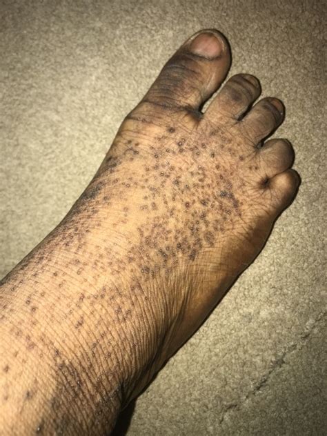 Black Spot On Legs And Wrist Health Nigeria