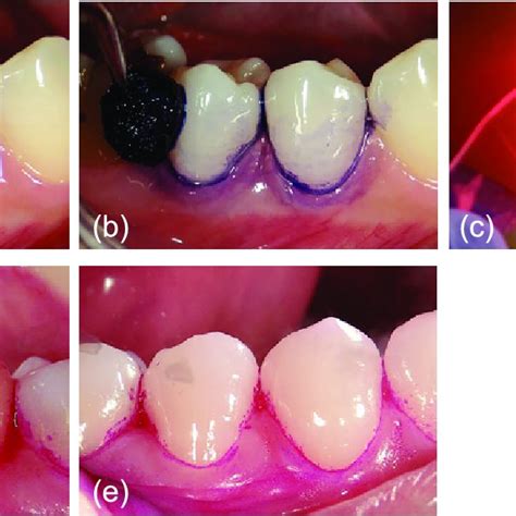 Pdf Application Of Antimicrobial Photodynamic Therapy In Dental