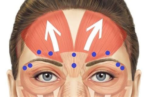 Brow lift can improve the appearance of: Pin on Injectable Education