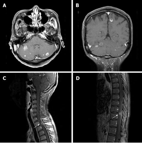 Magnetic Resonance Imaging Of The Brain And Spine On Axial A And