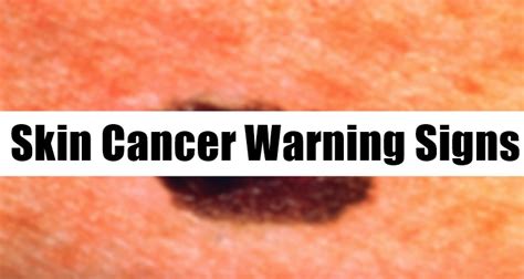Basal Skin Cancer Warning Signs