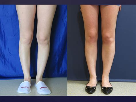 Estetica Europe Curved Lower Legs And Calf Implants Ru