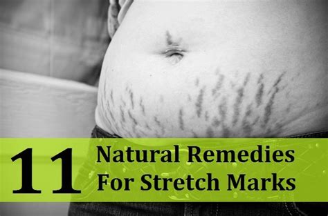 11 Natural Remedies For Stretch Marks