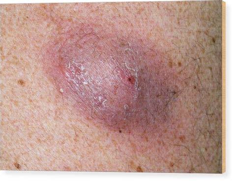 Infected Sebaceous Cyst On Back Photograph By Dr P Marazziscience