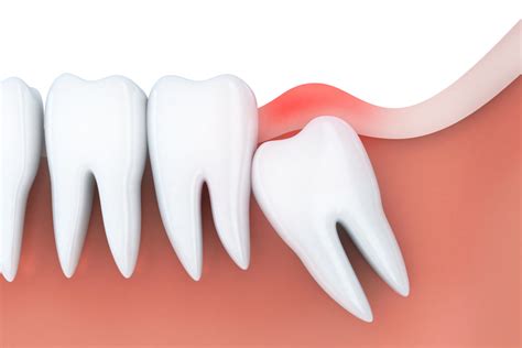 Preventing Wisdom Teeth From Changing Smiles Santa Rosa Oral Surgery