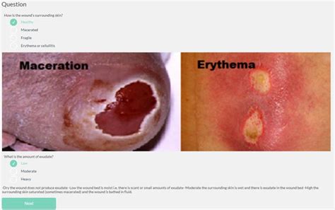 'when choosing a dressing, focus on protecting the surrounding skin from maceration, filling in a crevice if the wound is deep, and stimulating the growth of granulation tissue and epithclialization.' 29-Patient Assessment Questions 30-Exudate and Surrounding ...