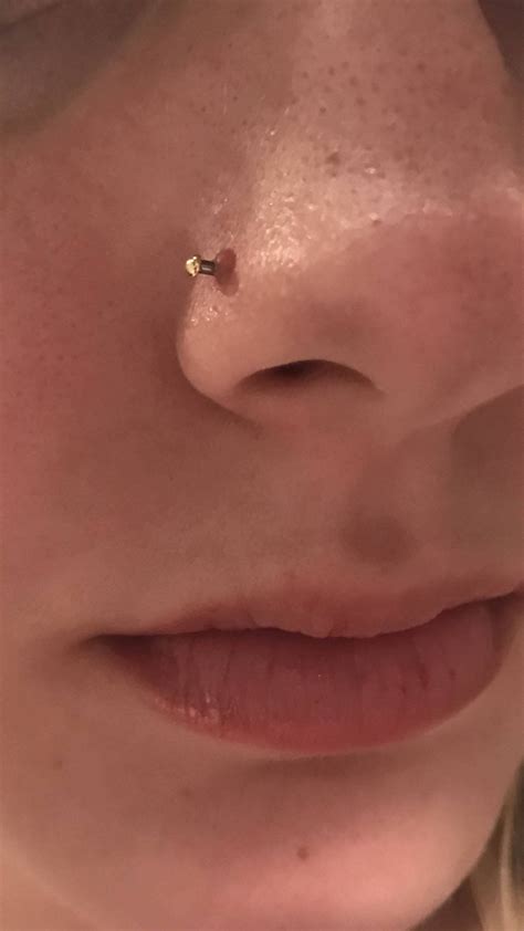 Pus Filled Bump On Nose Piercing Ubicaciondepersonascdmxgobmx